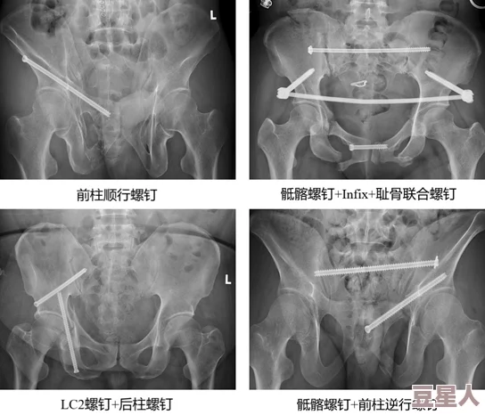 骨科11h叔叔：最新研究揭示骨折愈合过程中的关键因素与治疗新方法，助力患者早日康复