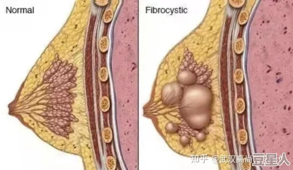 青春期乳房一抓捏里面有硬块可能是正常乳腺发育或纤维腺瘤建议及时就医检查