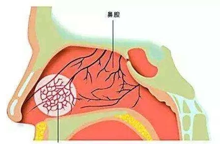 鼻子堵塞10秒解决夸大宣传无效退款难谨慎选择切勿轻信